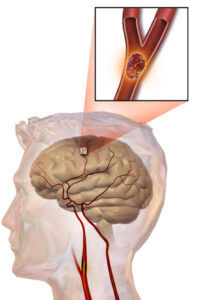 Ischemicka mozgova porazka