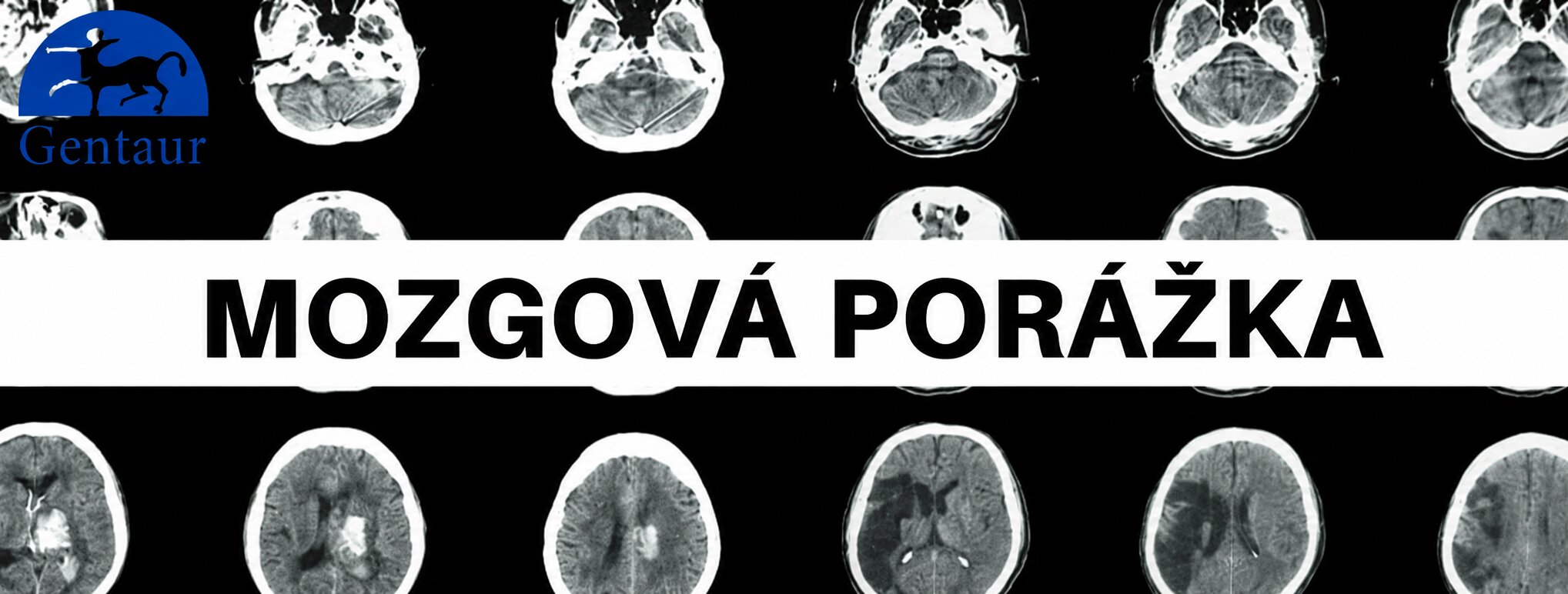 Mozgova porazka – najdolezitejsie informacie